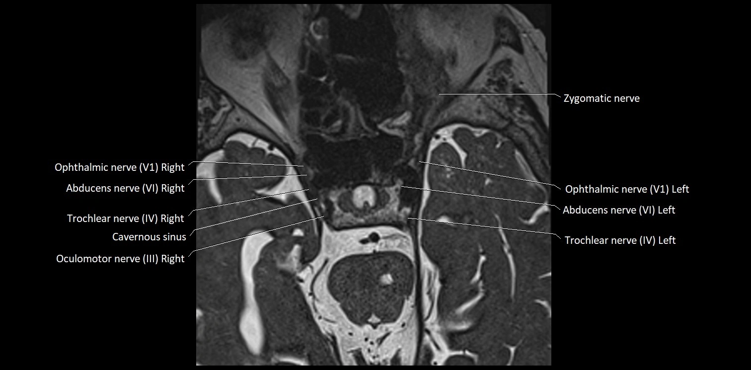 Cranial nerve anatomy axial MRI 3T image 27.webp